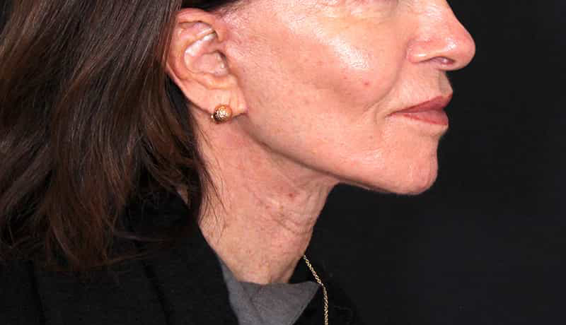 Necklift Before & After Photo