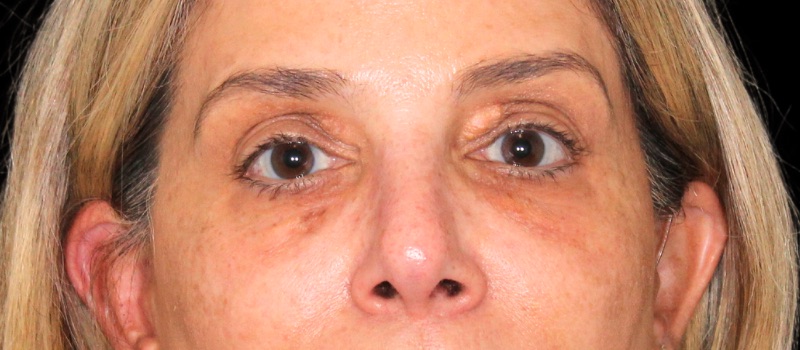 Blepharoplasty Before & After Photo