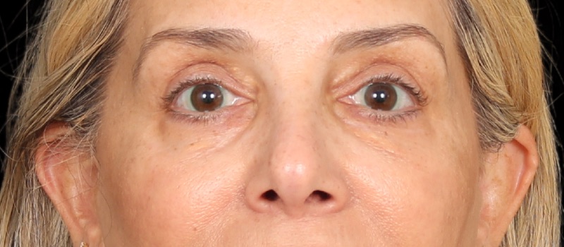 Blepharoplasty Before & After Photo