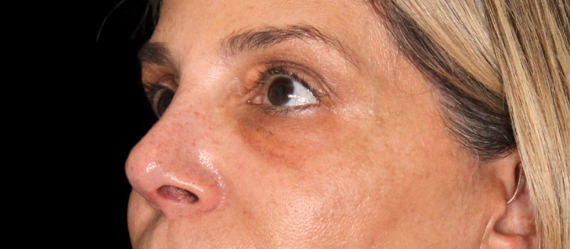 Blepharoplasty Before & After Image