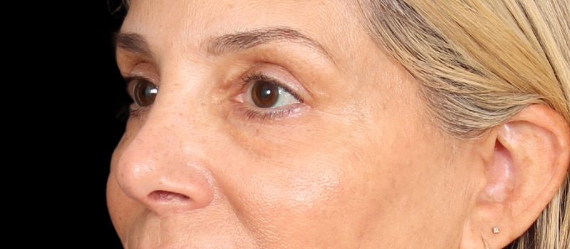 Blepharoplasty Before & After Image