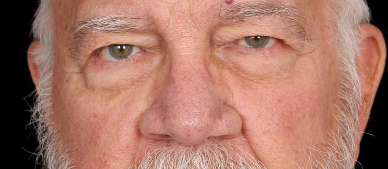 Blepharoplasty Before & After Photo