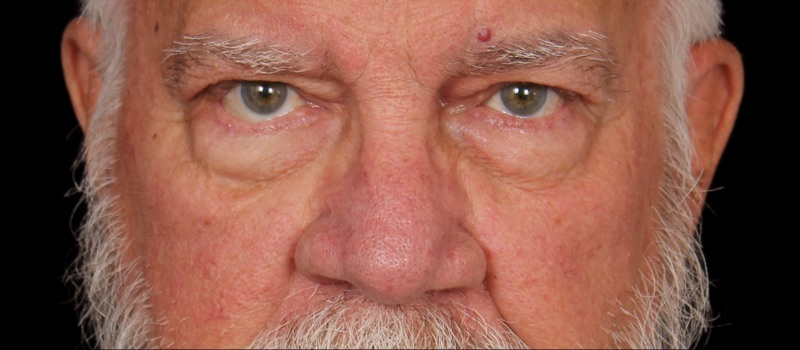 Blepharoplasty Before & After Photo