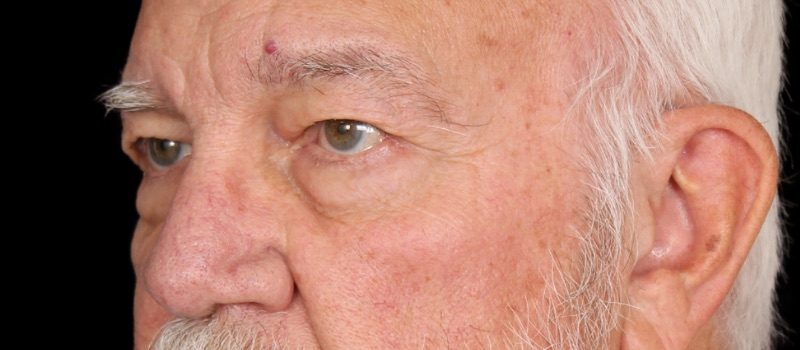 Blepharoplasty Before & After Image