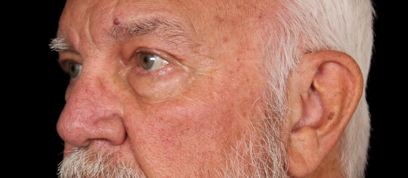 Blepharoplasty Before & After Image