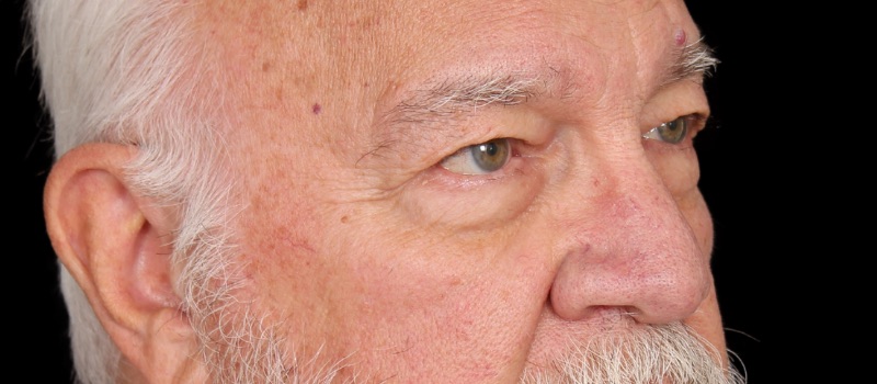 Blepharoplasty Before & After Image