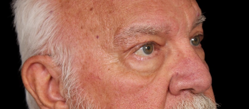 Blepharoplasty Before & After Image