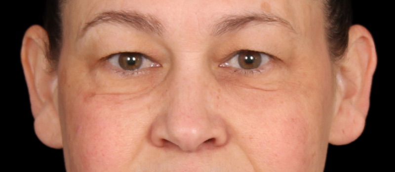 Blepharoplasty Before & After Photo