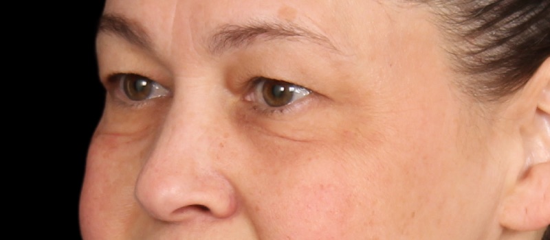 Blepharoplasty Before & After Image