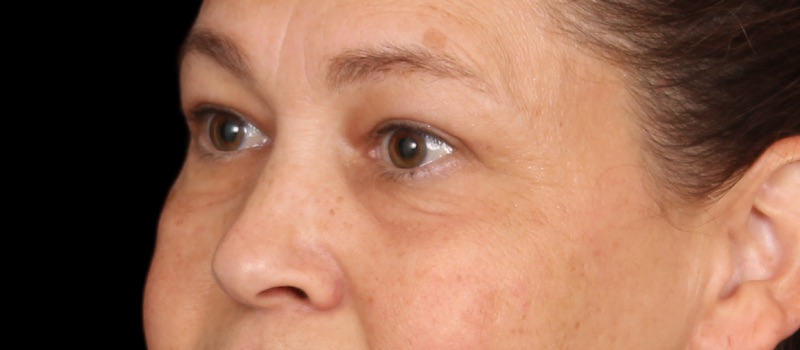 Blepharoplasty Before & After Image