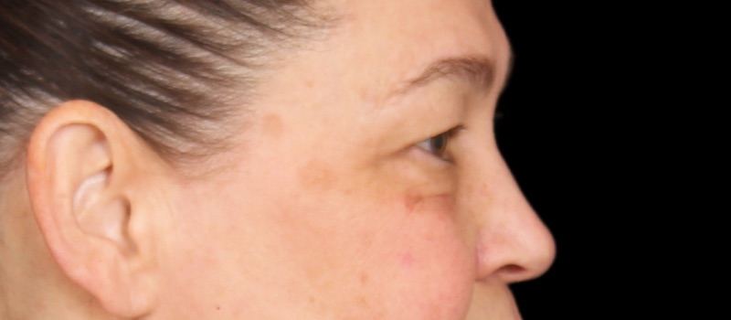 Blepharoplasty Before & After Image