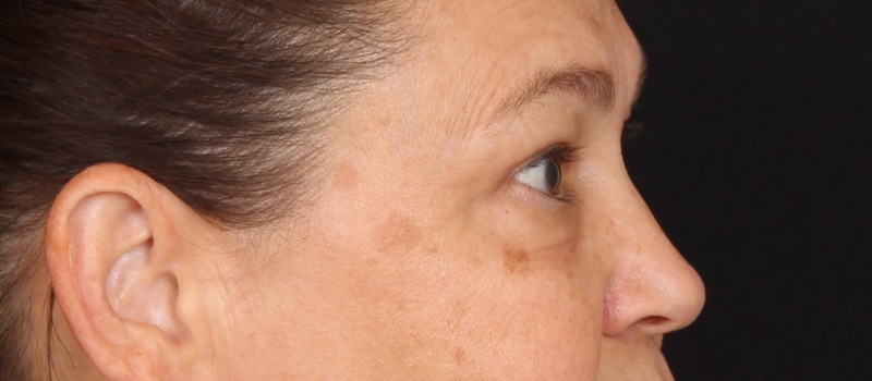 Blepharoplasty Before & After Image