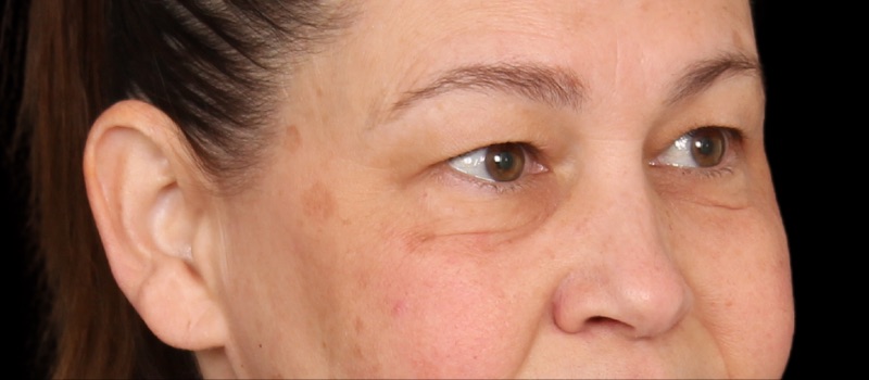 Blepharoplasty Before & After Image