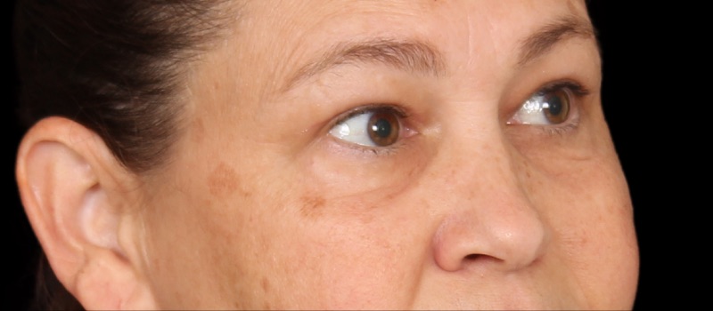 Blepharoplasty Before & After Image