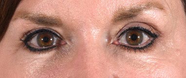 Blepharoplasty Before & After Photo