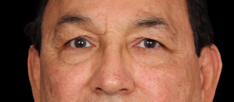 Blepharoplasty Before & After Photo