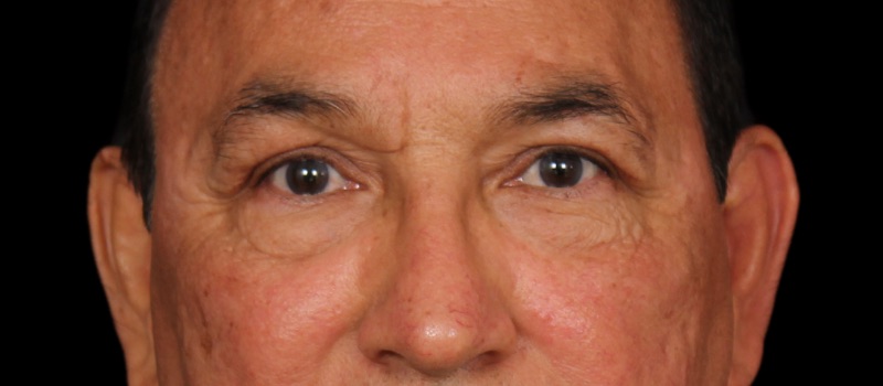 Blepharoplasty Before & After Photo
