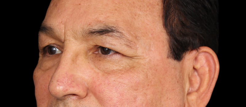 Blepharoplasty Before & After Image