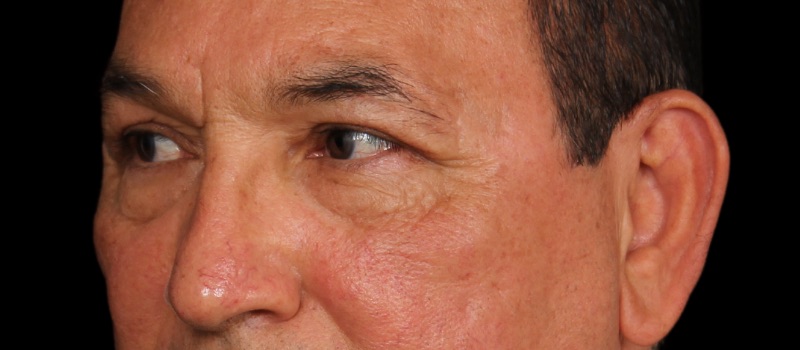 Blepharoplasty Before & After Image