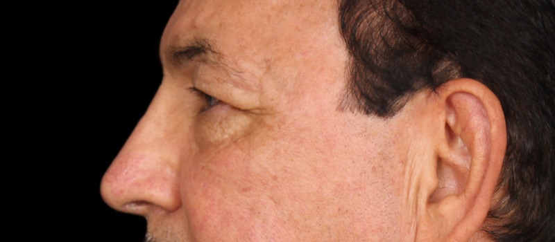 Blepharoplasty Before & After Image