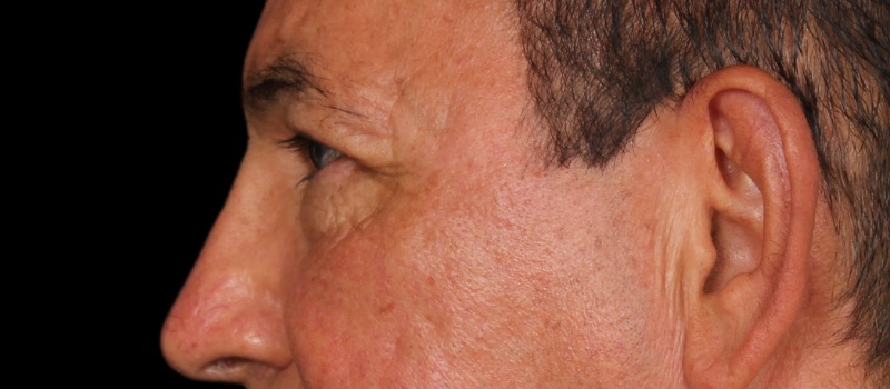 Blepharoplasty Before & After Image