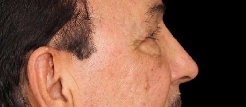 Blepharoplasty Before & After Image