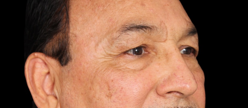 Blepharoplasty Before & After Image