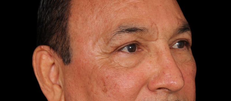 Blepharoplasty Before & After Image