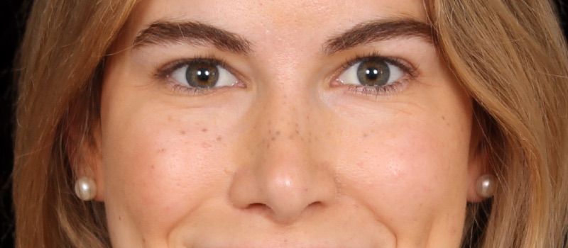 Blepharoplasty Before & After Photo