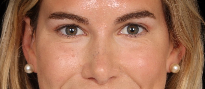 Blepharoplasty Before & After Photo