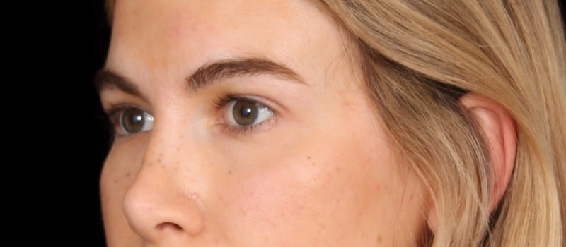 Blepharoplasty Before & After Image
