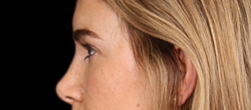 Blepharoplasty Before & After Image