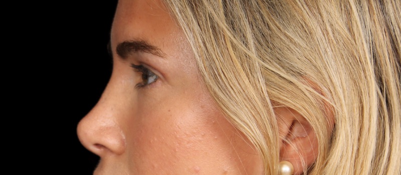 Blepharoplasty Before & After Image