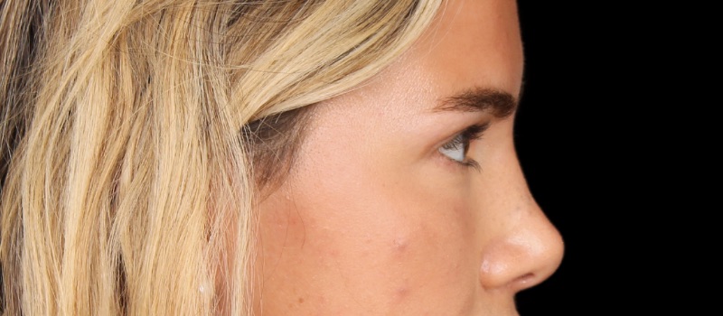 Blepharoplasty Before & After Image