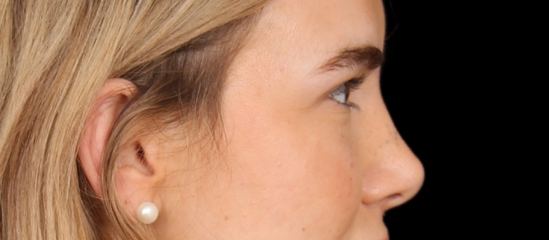 Blepharoplasty Before & After Image