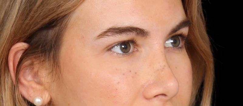 Blepharoplasty Before & After Image