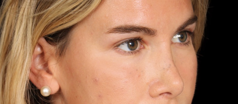 Blepharoplasty Before & After Image
