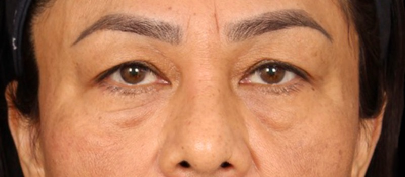 Blepharoplasty Before & After Photo