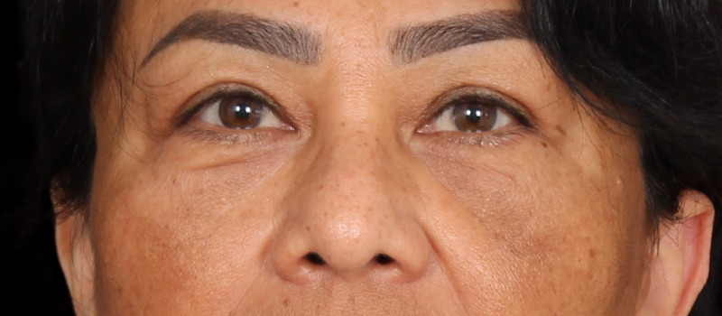 Blepharoplasty Before & After Photo