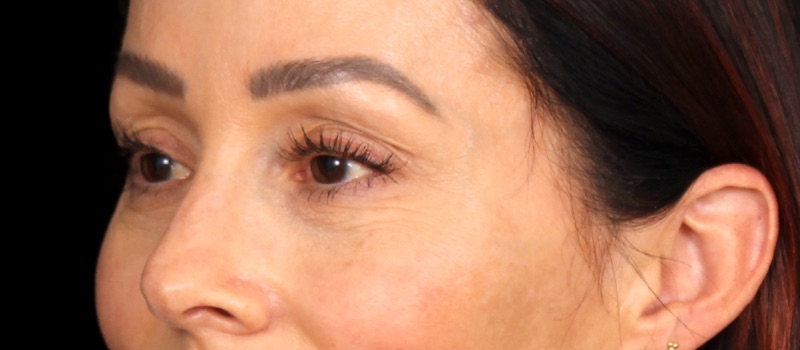 Blepharoplasty Before & After Photo