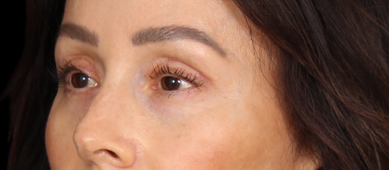 Blepharoplasty Before & After Photo