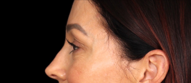 Blepharoplasty Before & After Image