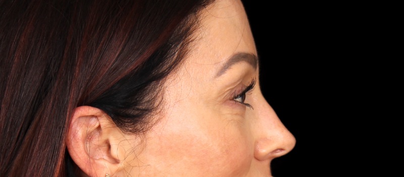 Blepharoplasty Before & After Image