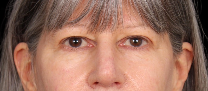 Blepharoplasty Before & After Photo