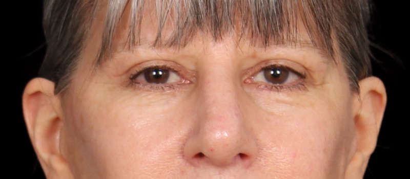 Blepharoplasty Before & After Photo