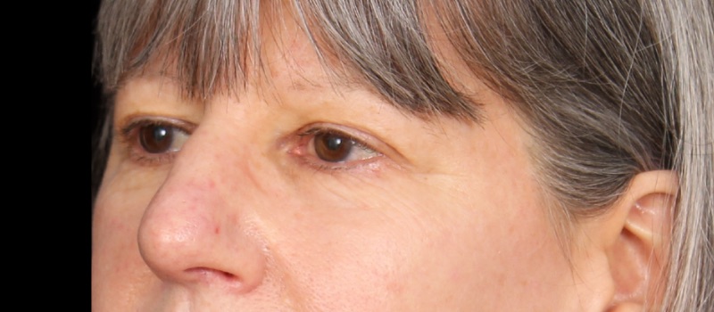 Blepharoplasty Before & After Image