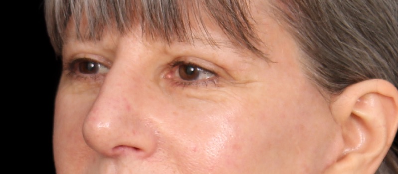 Blepharoplasty Before & After Image