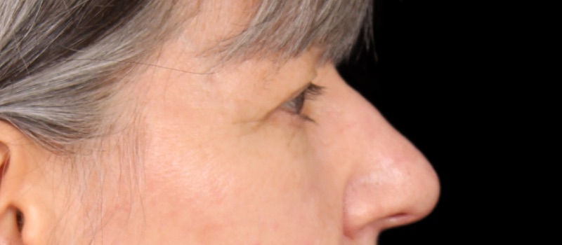 Blepharoplasty Before & After Image