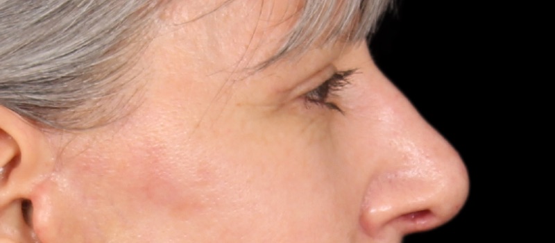 Blepharoplasty Before & After Image