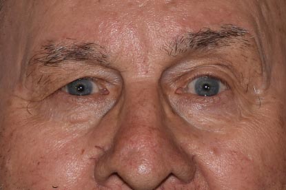 Brow Lift Before & After Photo